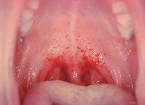 энтеровирус поражение горла и сыпь