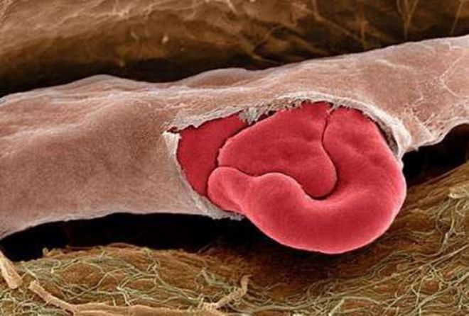 красные кровяные тельца выходят из лопнувшего капилляра