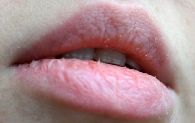 Шелушащиеся губы