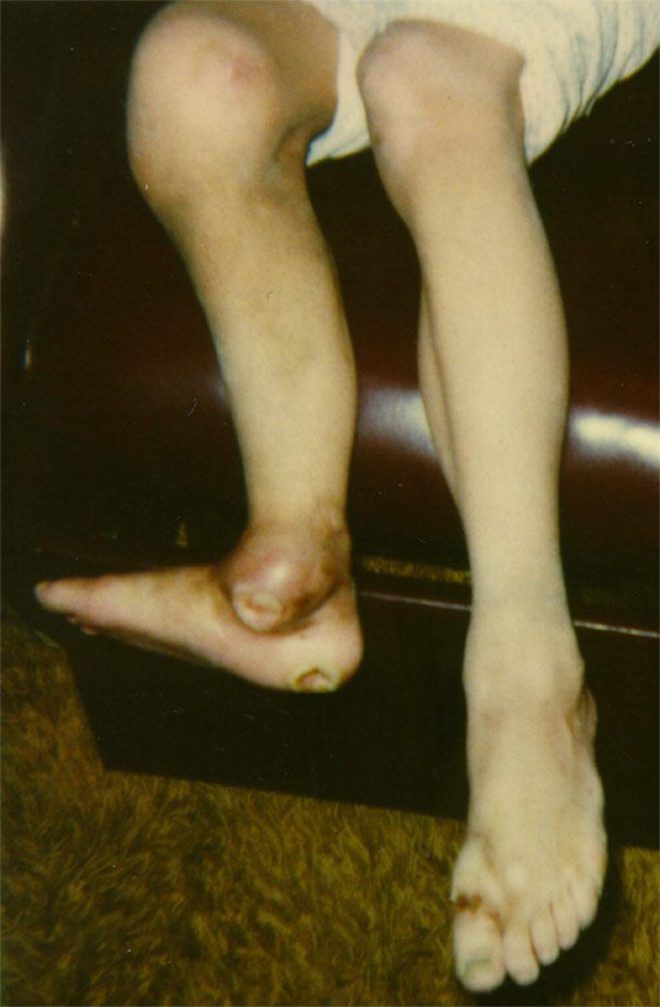 Деформированные ноги
