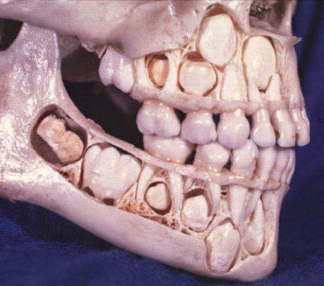Зачатки зубов в детском черепе