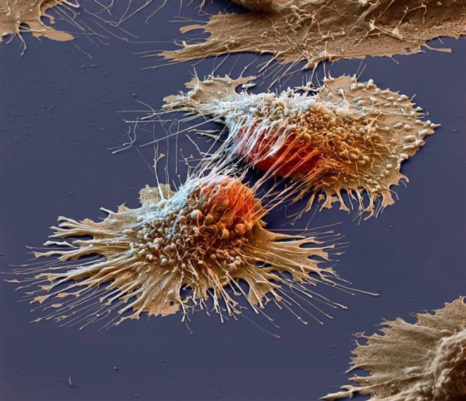 Клетки рака под микроскопом