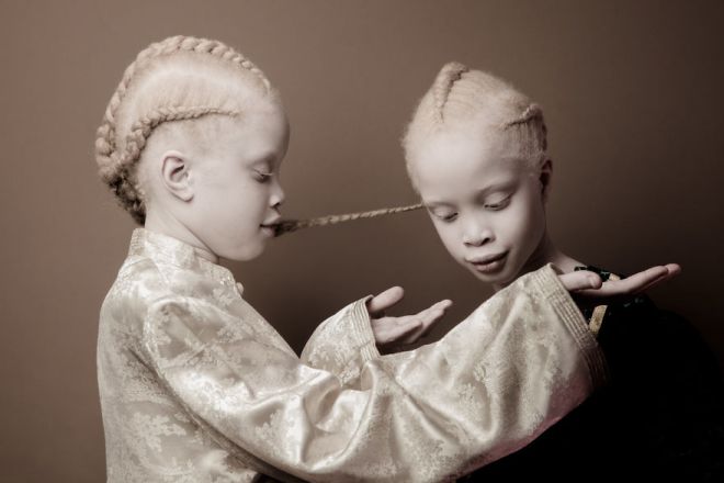 девочки альбиносы