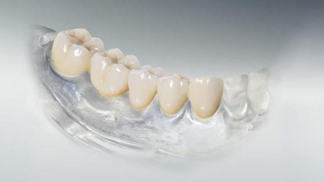 Установка металлокерамической коронки предполагает депульпирование зуба