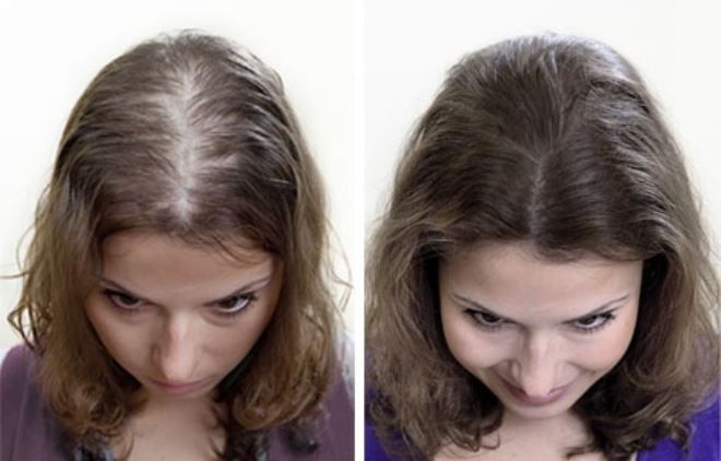 пересадка волос у женщин