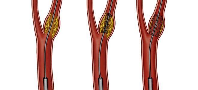 фото1 стенозы сонных артерий