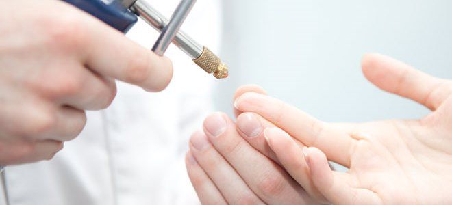how to get rid of wart on finger