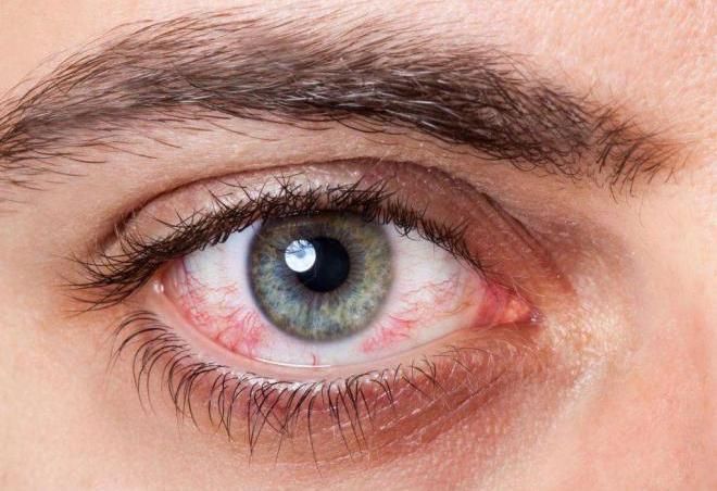 При синдроме сухого глаза нельзя носить линзы