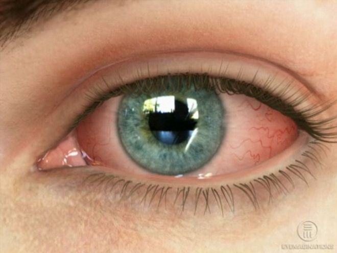 Инфицирование слизистой глаз