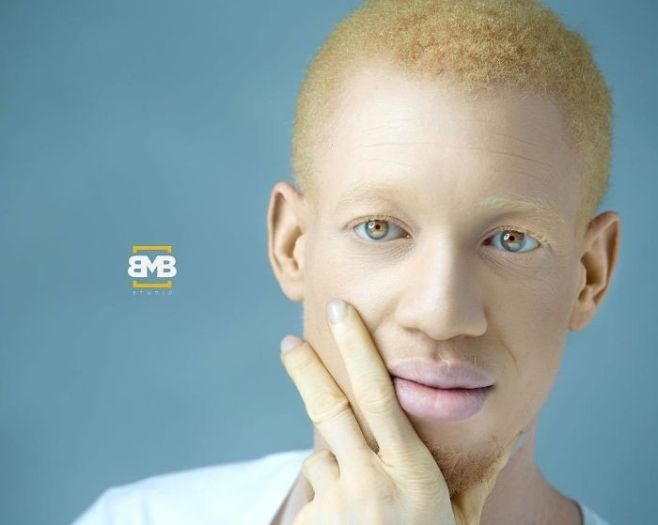 Негр альбинос