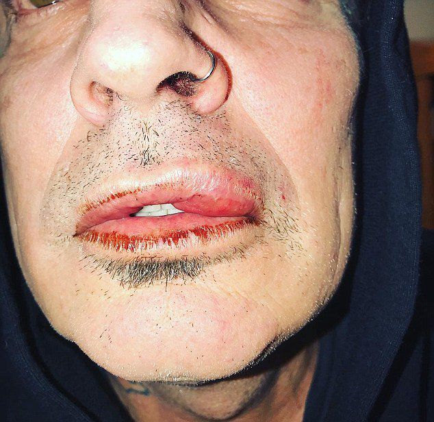 Фото Томми Ли с разбитой губой