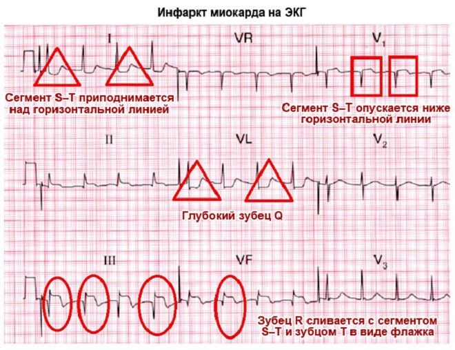 электрокардиограмма при инфаркте миокарда