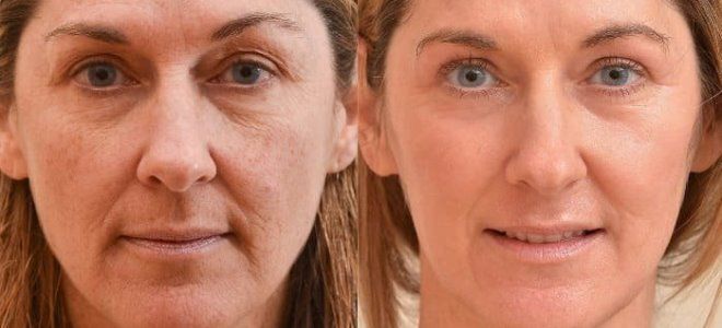 плазмолифтинг лица до и после фото