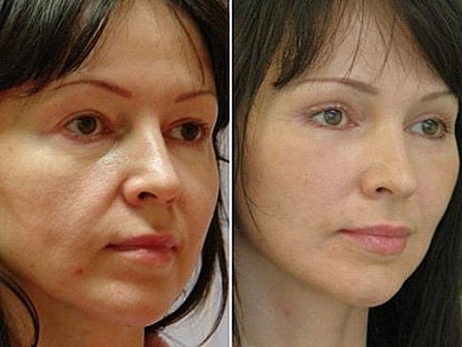 буккальный массаж лица до и после фото