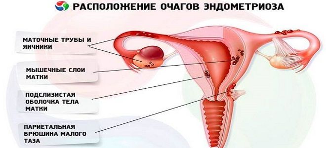 симптомы эндометриоза матки