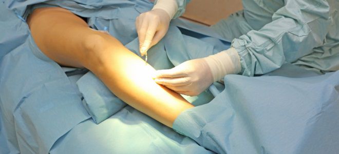 хирургическое лечение варикоза вен ног