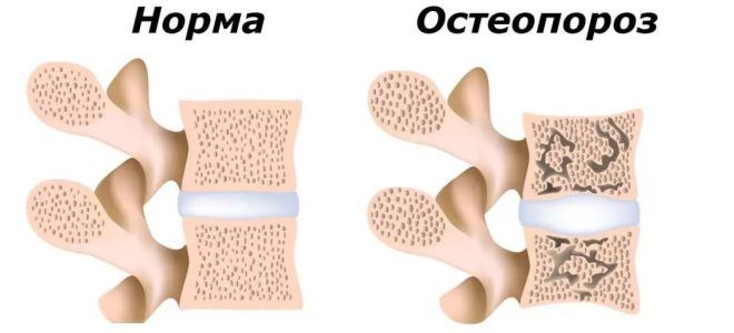 виды остеопороза