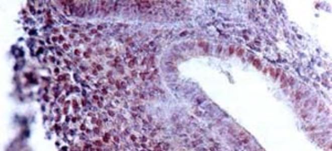 гиперплазия эндометрия матки
