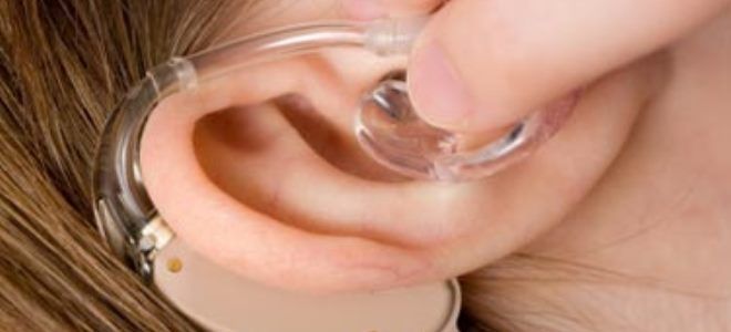 кохлеарная имплантация уха