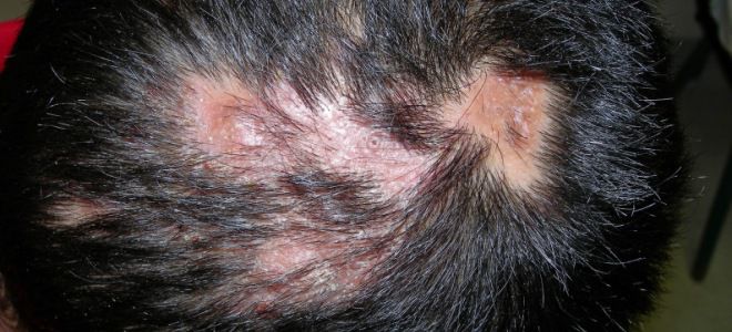 Skin diseases on the head ringworm