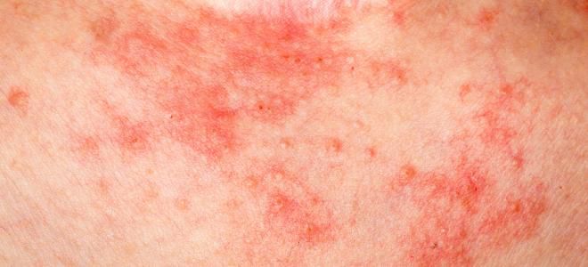 Skin diseases on the body eczema