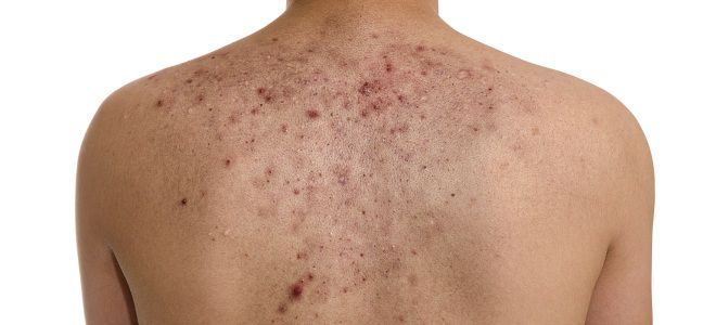 Skin diseases on the body acne