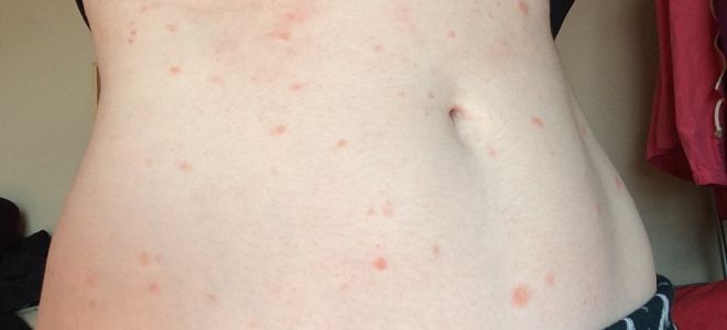 Skin diseases on the body pink lichen