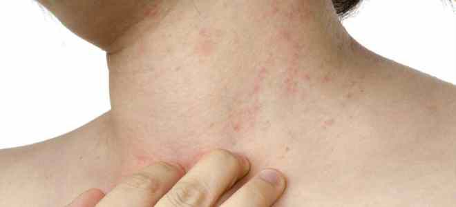 Skin diseases on the body allergic dermatitis