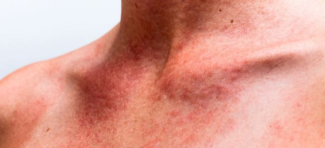 Skin diseases on the body urticaria