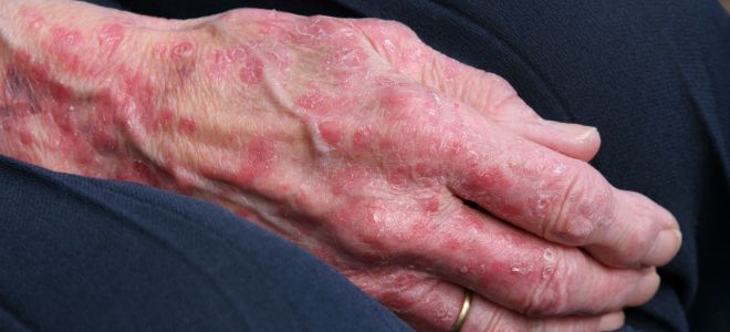 Skin diseases on the hands eczema