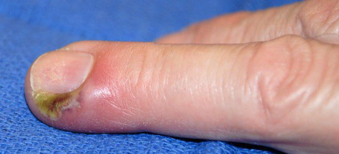 Skin diseases on the hands of panaritium