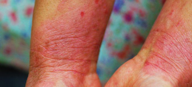 Skin diseases on the hands neurodermatitis