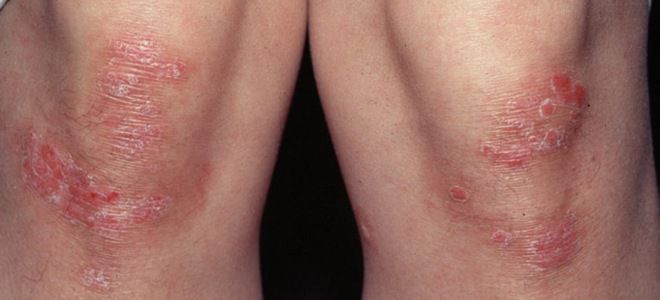 Skin diseases on the legs psoriasis
