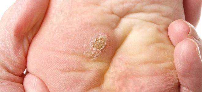 Skin diseases on the feet plantar warts