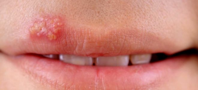 Skin diseases on the face herpes