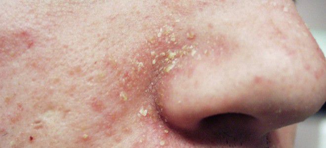 Skin diseases on the face seborrheic dermatitis