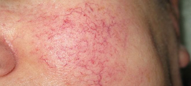 Skin diseases on the face seborrheic rosacea