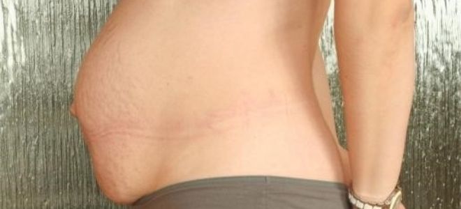 Грыжа околопупочная у женщин лечение без операции thumbnail