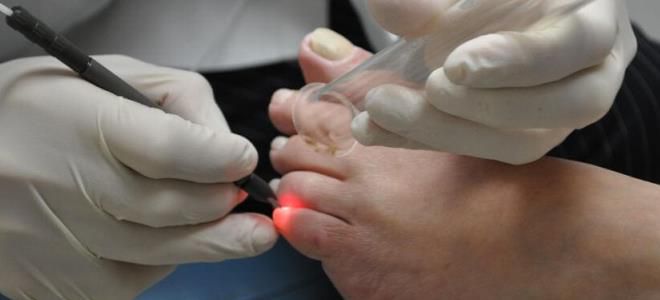laser ingrown toenail removal