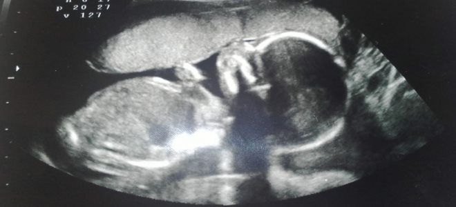 Узи 29 недель беременности мальчик фото