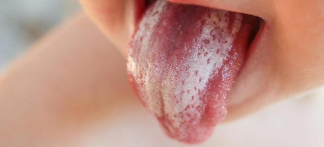 лечение кандидоза полости рта