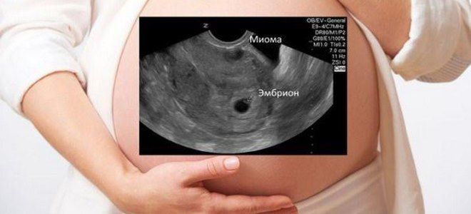 миома и беременность