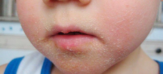Стрептодермия фото под носом у детей