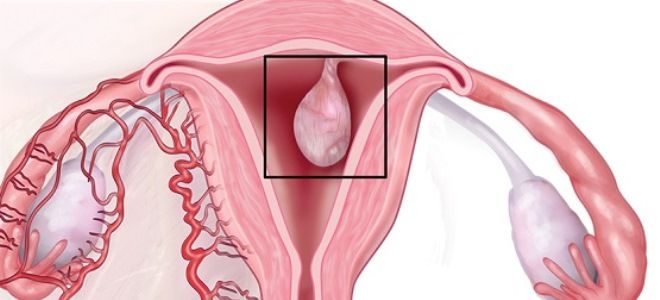 полипы эндометрия в матке