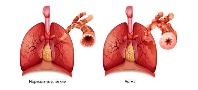 признаки астмы