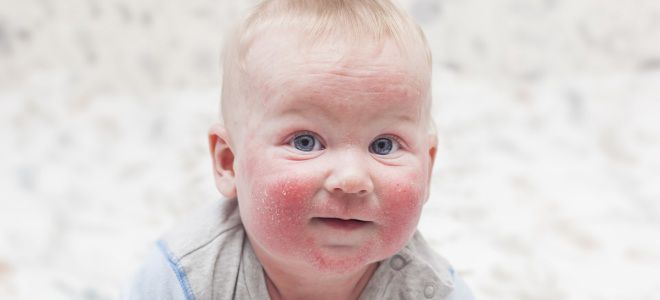 Как проявляется пищевая аллергия у детей