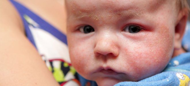 Аллергия у детей от приема пищи thumbnail