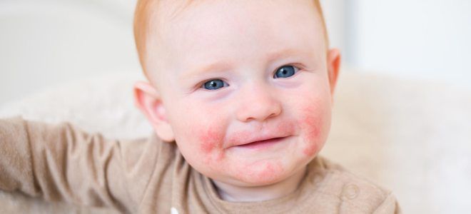 Через какое время проявляется аллергия у детей на продукты thumbnail