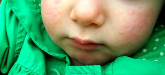 Через сколько проявляется аллергия у ребенка thumbnail