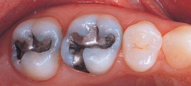 Виды зубных пломб металл